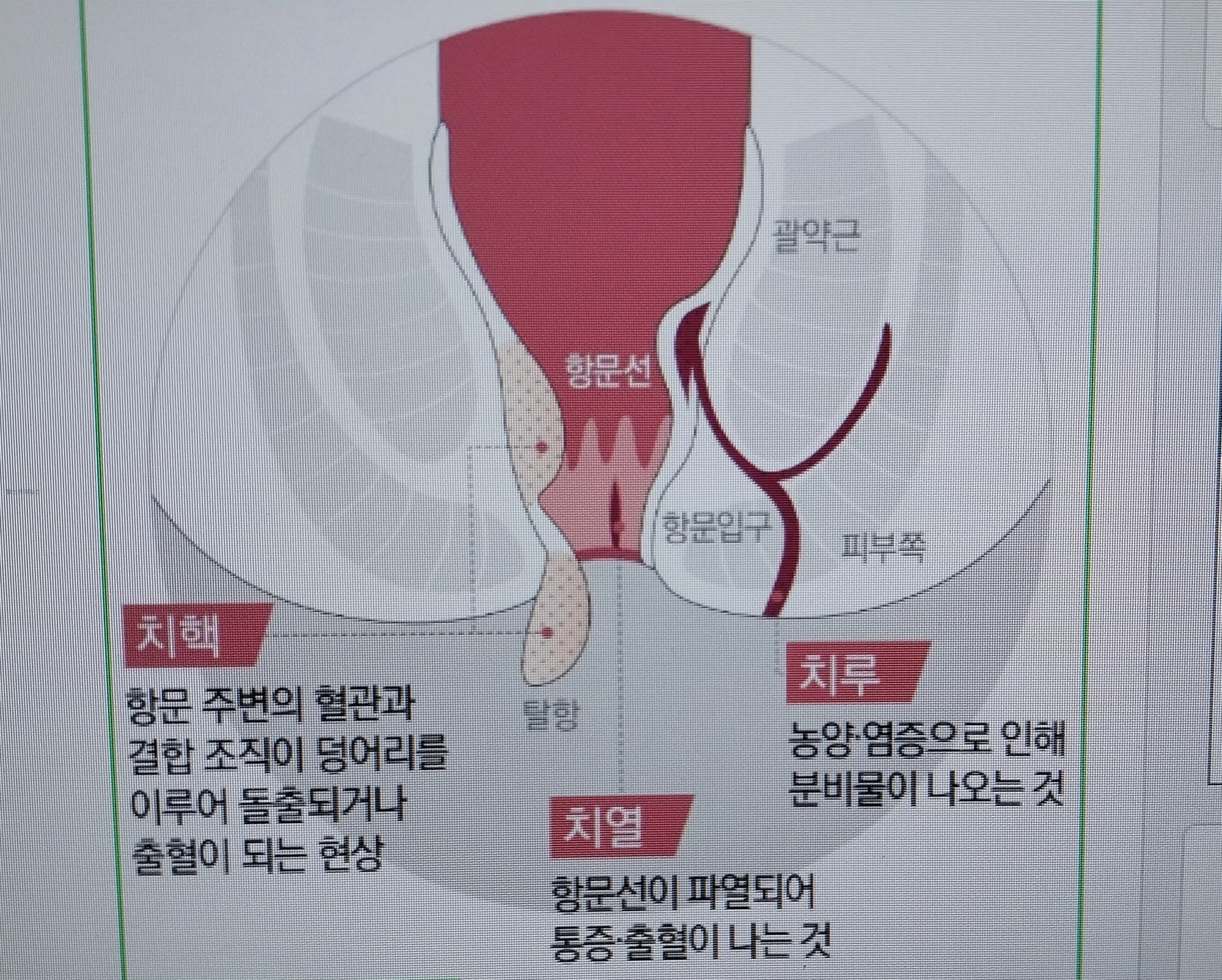 치질, 예방이 최선이다