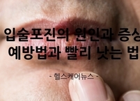 입술포진의 원인과 증상 예방법과 빨리 낫는 법