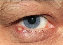 잘 낫지 않는 눈꺼풀 염증질환 ‘안검염’