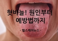 입안에 돋은 붉은 신호등, 혓바늘! 원인부터 예방법까지