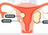 자궁근종 원인, 증상, 치료, 경과 및 합병증 등