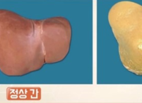 지방간에 예방법과 발효식품