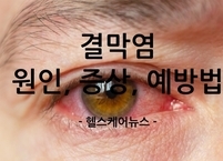여름철 주의해야 할 결막염 원인, 증상, 예방법