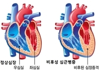 [medical news] 비후성 심근증 환자 좌심실 박출률이 낮을수록 심장 돌연사 위험 커져