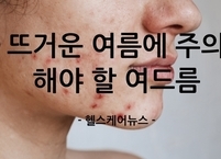 뜨거운 여름에 주의해야 할 여드름 관리법