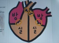 부정맥 치료의 혁신적 기술, 펄스장 절제술