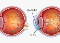 ‘소리 없는 실명’ 녹내장 원인과 증상 및 진단과 치료