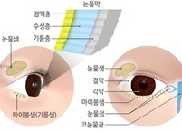 안구 건조증 원인과 증상 및 치료와 예방법