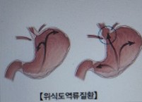 위식도역류질환에 특효약인 감자