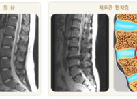 꼬부랑 할머니병