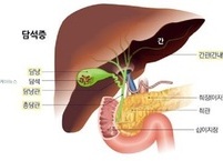 담석증 원인과 증상, 치료 및 예방 법