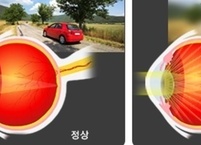 백내장 원인과 증상 및 수술 시기