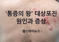 환절기 면역력 틈타 깨어나는 '통증의 왕' 대상포진 원인과 증상