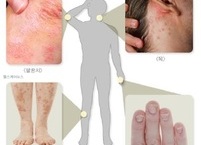 건선 원인 및 증상, 치료, 예방 관리 방법
