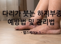 붓는 다리, 이제 안녕! 하지부종 예방법 및 관리법 