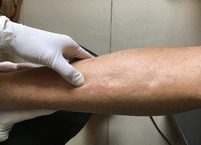 양말 자국 오래 남는 부종(浮腫)의 원인과 치료