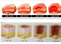 욕창 원인과 증상 및 치료와 예방 관리 방법
