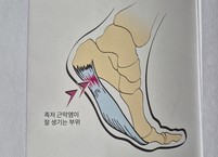엄살처럼 발바닥이 아픈 족저근막염