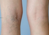 하지정맥류 원인과 치료 및 예방 법