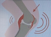 정형외과 의사들이 권장하는 무릎관절염 치료 방법