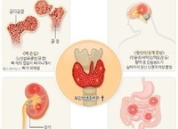 고칼슘혈증 원인과 증상 및 치료와 예방관리