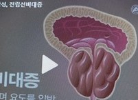 전립선비대증의 증상과 예방