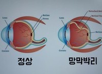 눈앞에 어른거리는 날파리, 비문증 치료할 수 있다
