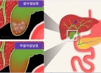 급성 담낭염은 원인과 증상 및 치료와 예방법