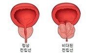 전립선비대증 막을 수 있다