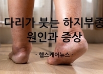 다리가 붓는 하지부종의 원인과 증상