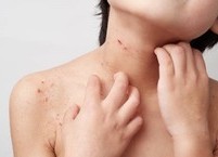 아토피도 식품 관리 잘하면 가라앉힐 수 있다