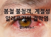 봄철 불청객, 계절성 알레르기성 결막염