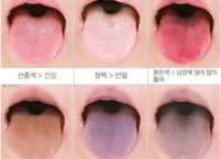 혀 색깔로 체크하는 질병 유무와 종류