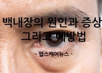 백내장의 원인과 증상, 그리고 내 눈을 지키는 생활 속 예방법 